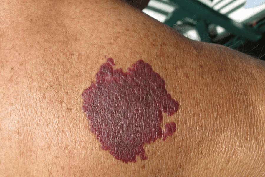 port wine stain