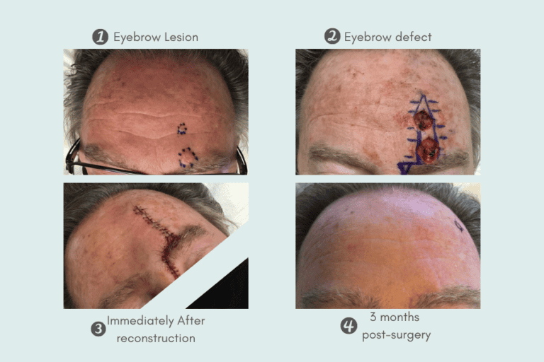 Mohs Surgery in Scottsdale & Paradise Valley Skin Cancer Surgery