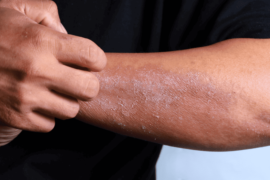 arm with eczema clear dermatology