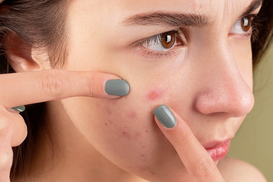 acne treatments in scottsdale dermatology