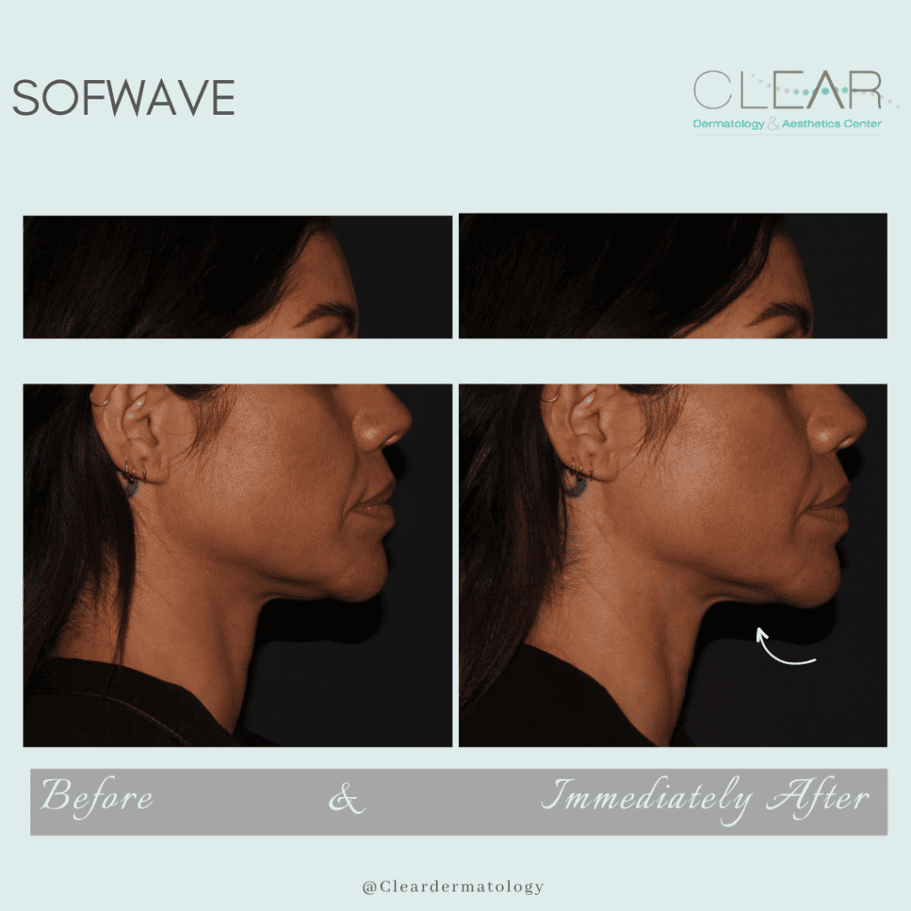 sofwave Before & after