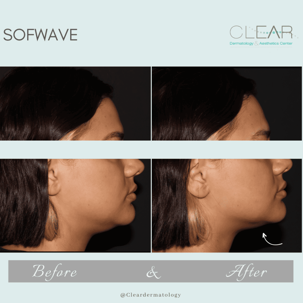 sofwave Before & after