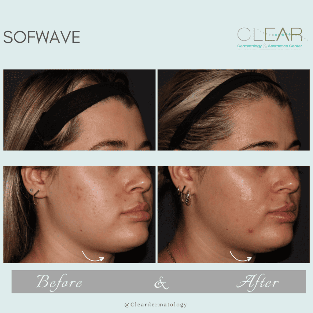 sofwave Before & after