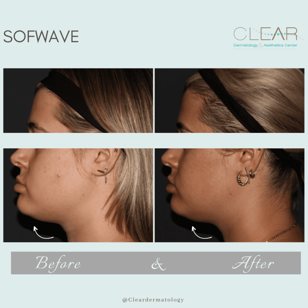 sofwave Before & after