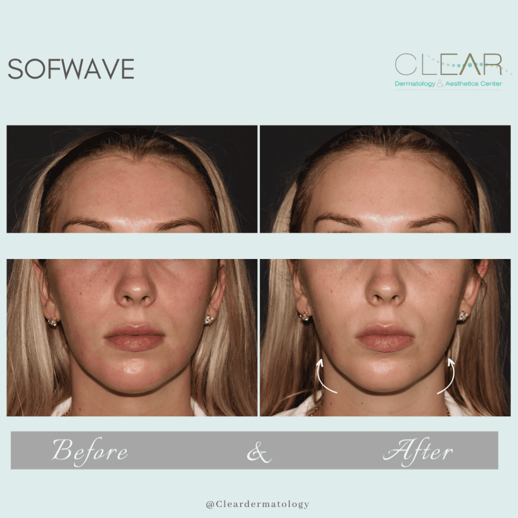 sofwave Before & after