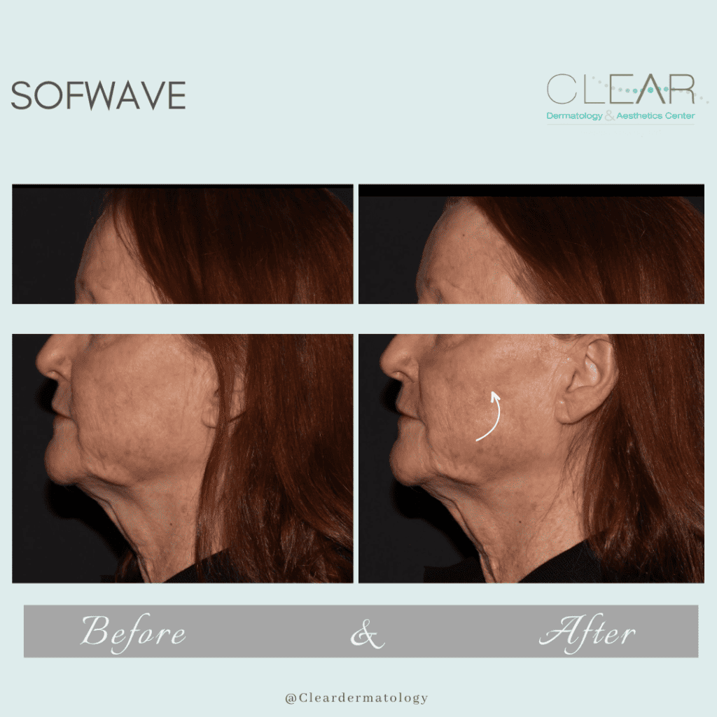 sofwave Before & after