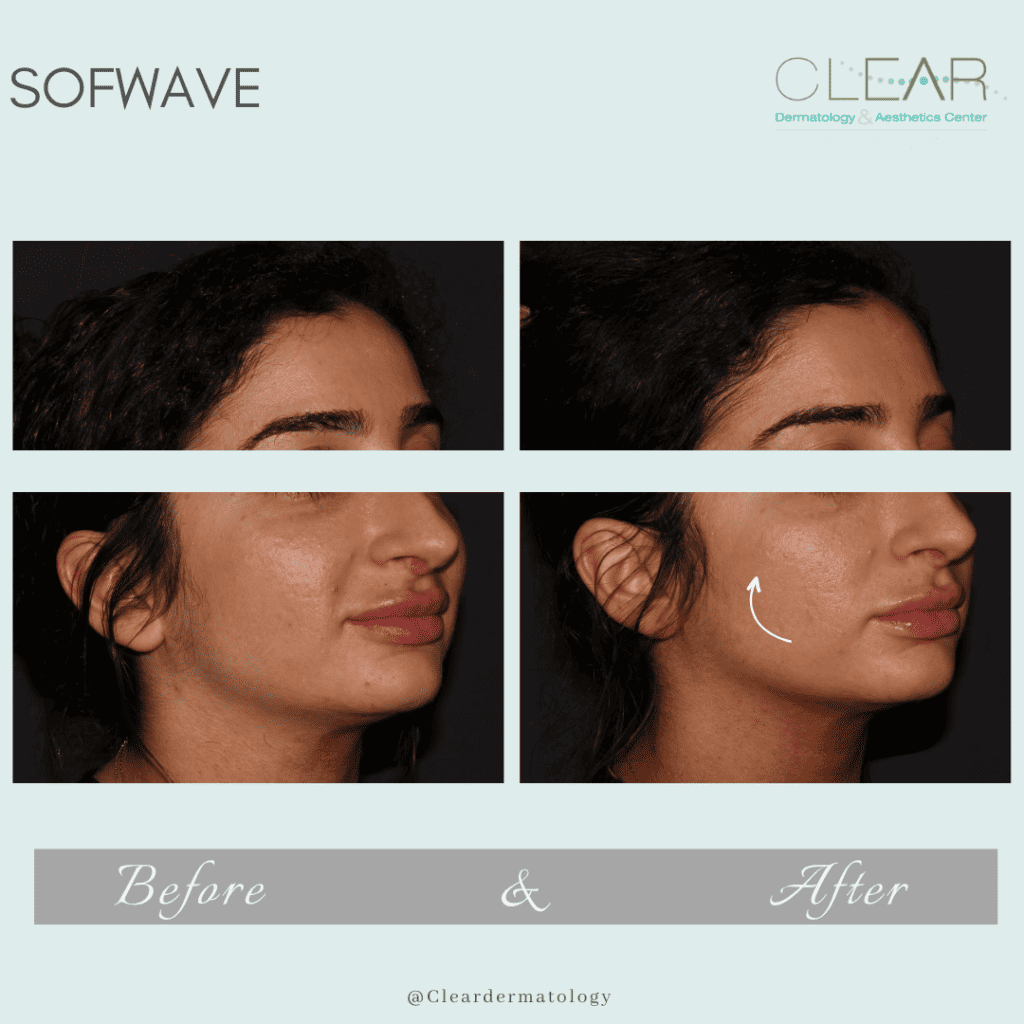 sofwave Before & after