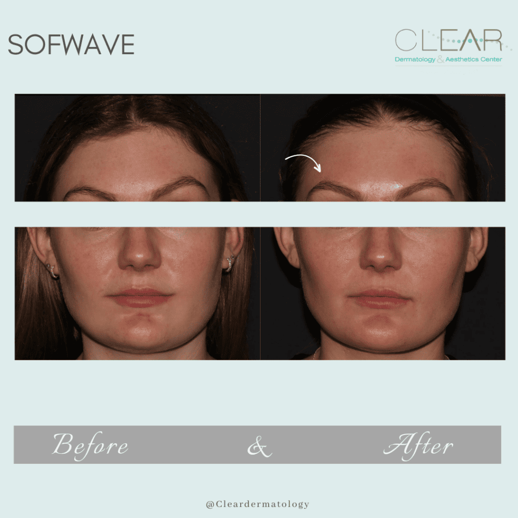 sofwave Before & after