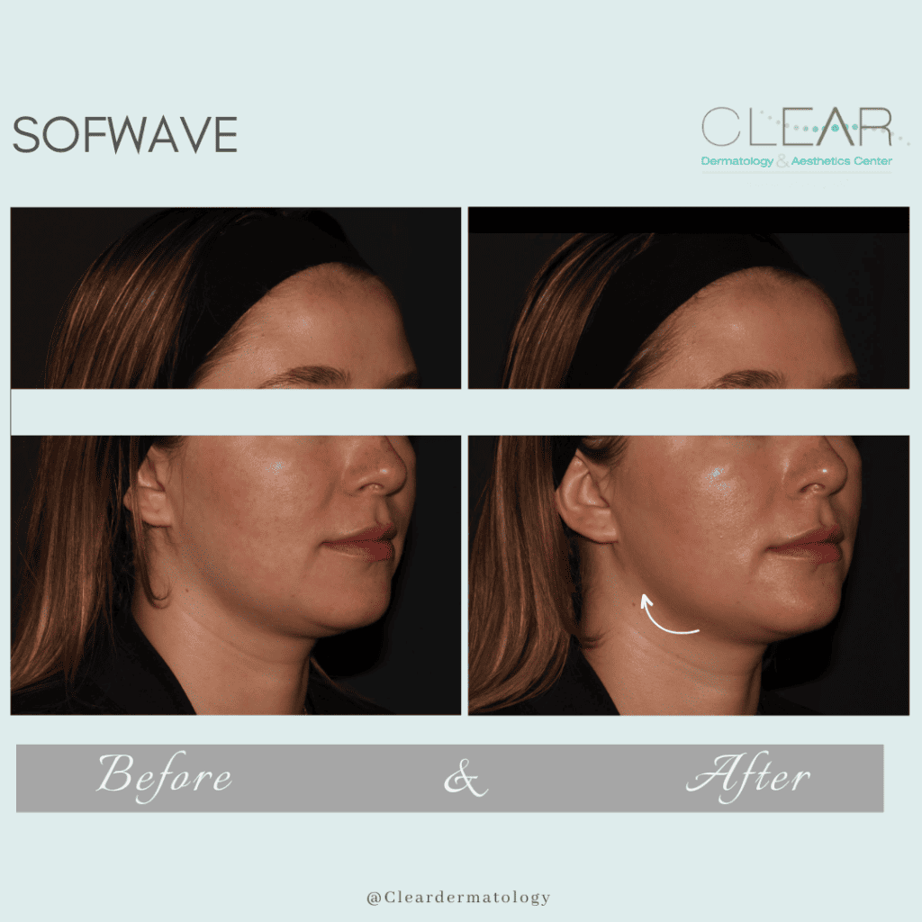sofwave Before & after