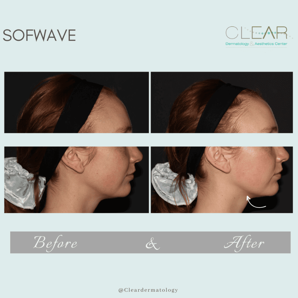 sofwave Before & after