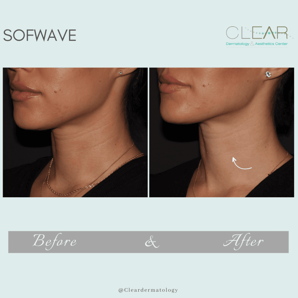 sofwave Before & after