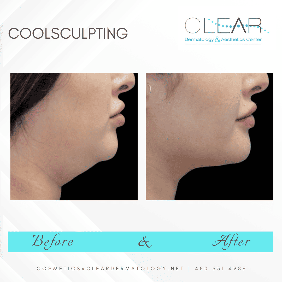 Coolsculpting before and after