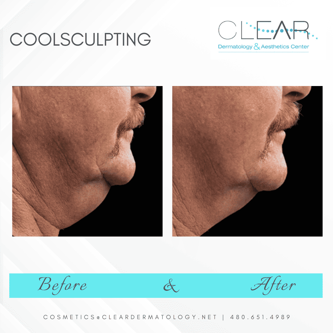 Coolsculpting before and after