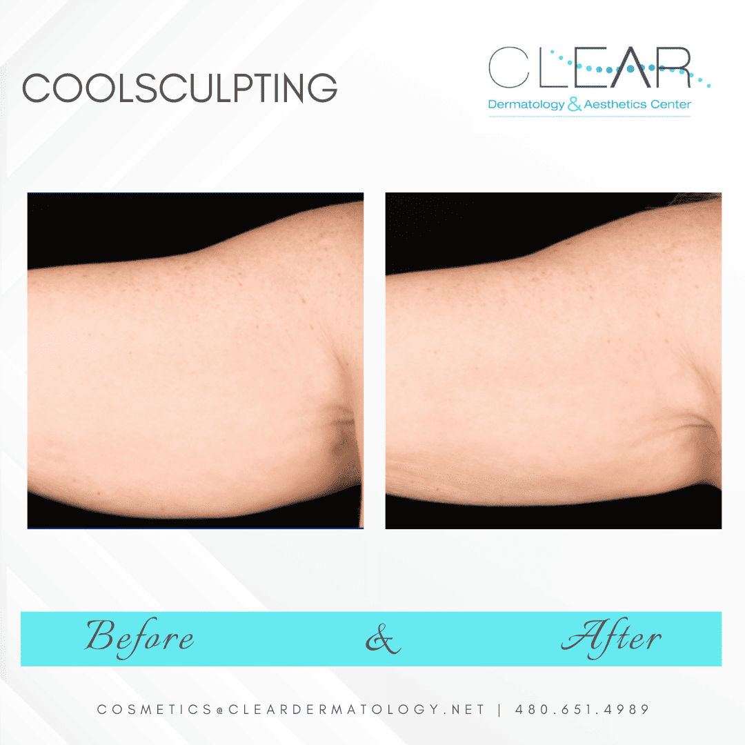 Coolsculpting before and after