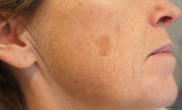 Brown Spots - Age Spots