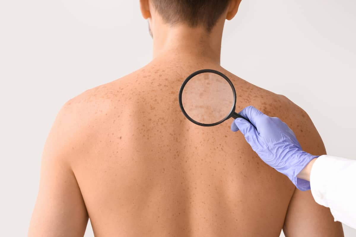 A doctor checking a patient for Skin Cancer and the Treatment Options available