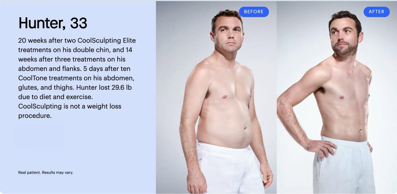 Coolsculpting-BnA-1-Large