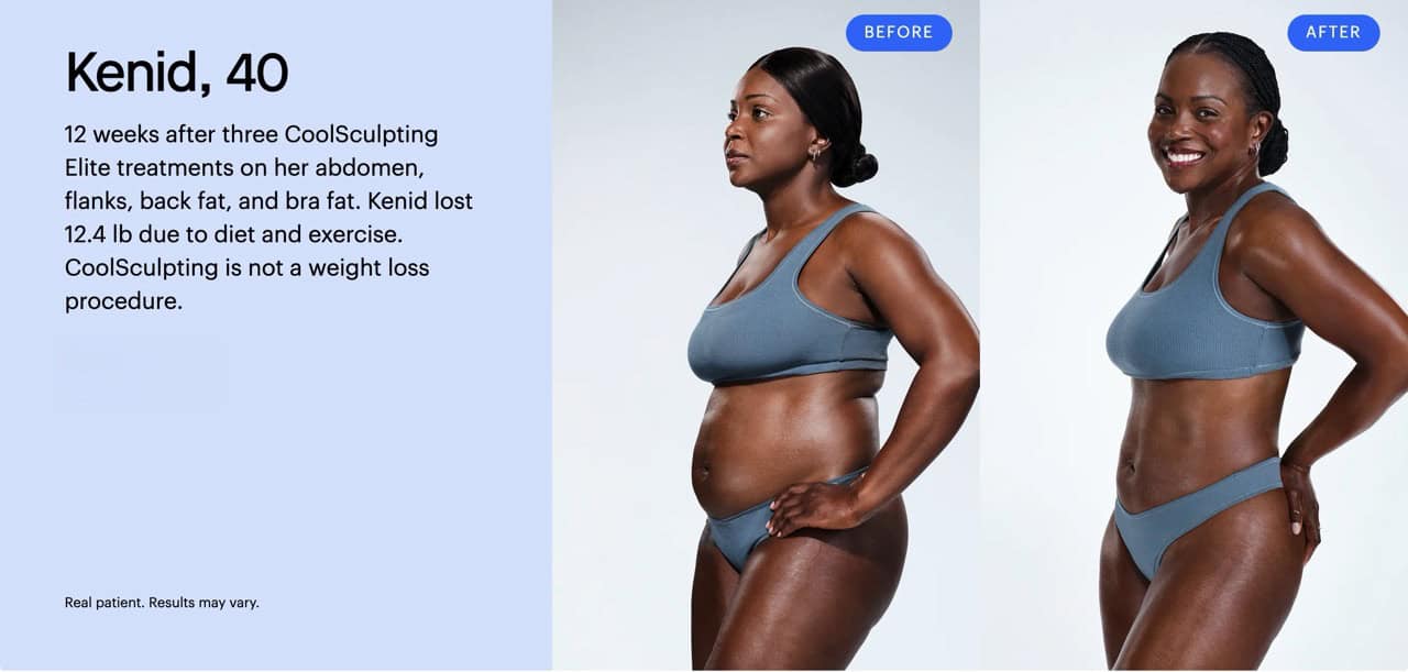 Coolsculpting-BnA-2-Large