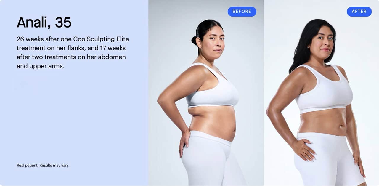 Coolsculpting-BnA-3-Large