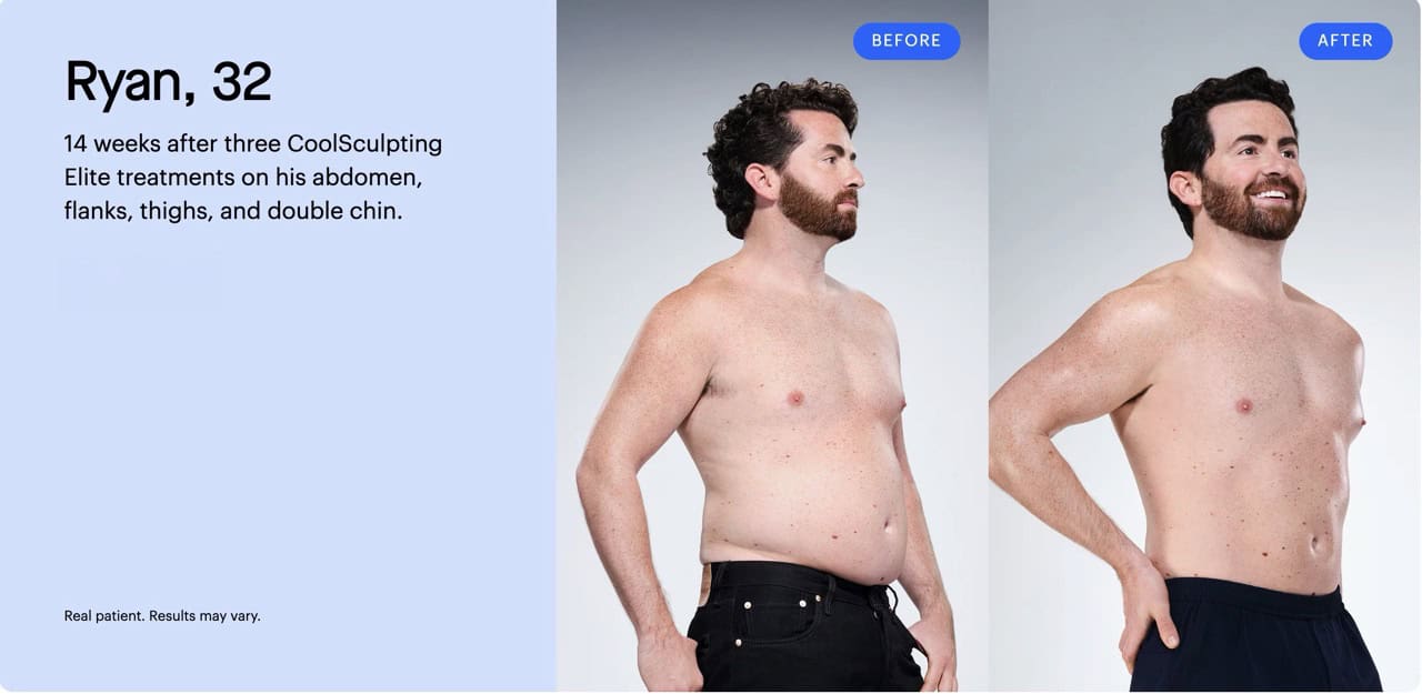 Coolsculpting-BnA-4-Large