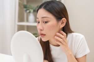 Melasma Treatment in Scottsdale AZ