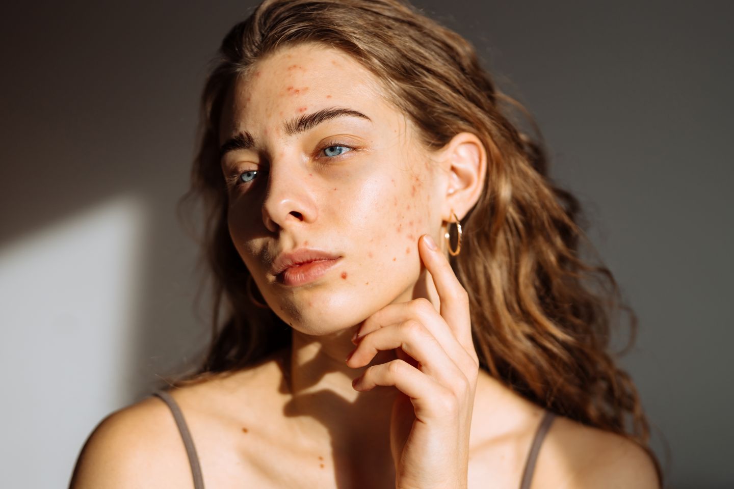 Pimple Treatment Options in Scottsdale AZ