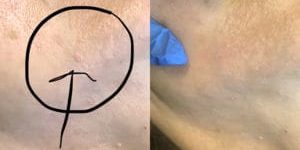 sebaceous-hyperplasia-300x300